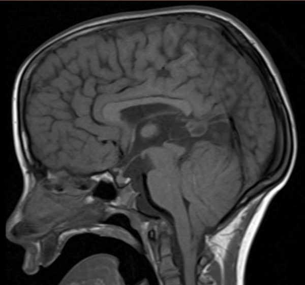 xray of brain with Chiari II malformation