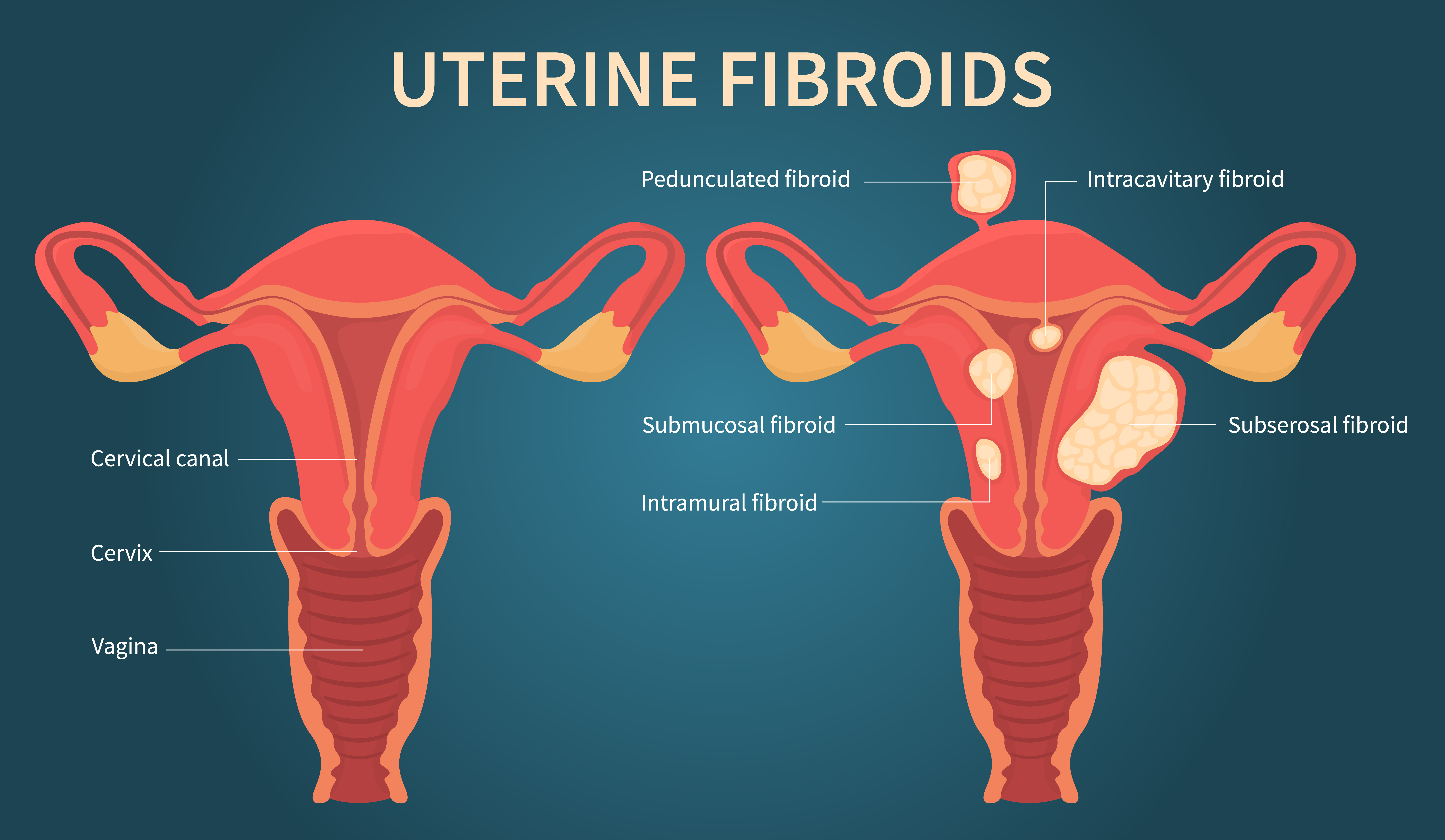 uterine fibroids graphic