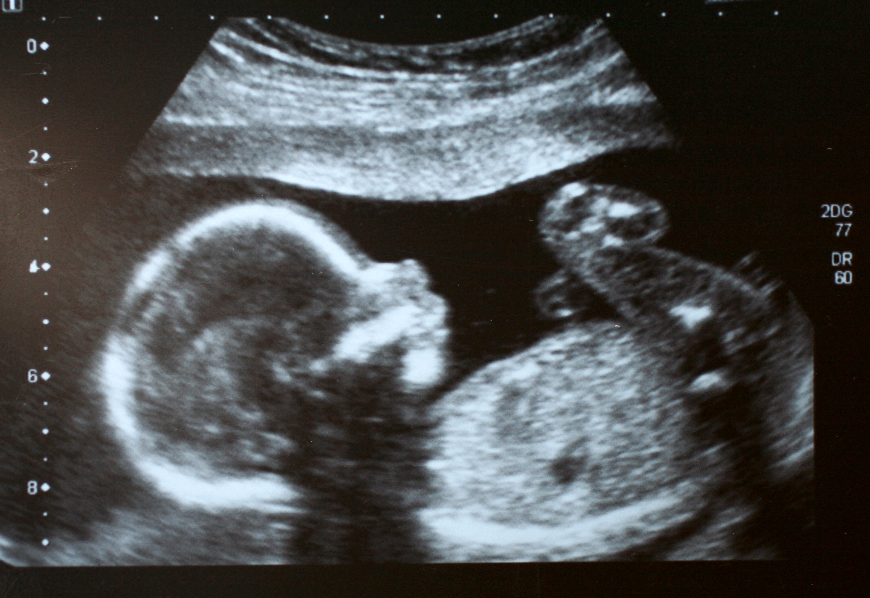 Pregnancy ultrasound showing baby on his or her back