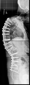 post-operative x-ray of patient with Ankylosing Spondylitis