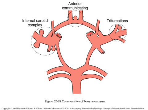 Common Sites for aneurysms