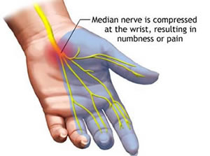 Median nerve and carpal tunnel syndrome