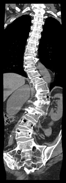 XRay of scoliosis