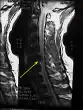 MRI of a spine