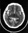 CT scan showing blood (white) in the subarachnoid space