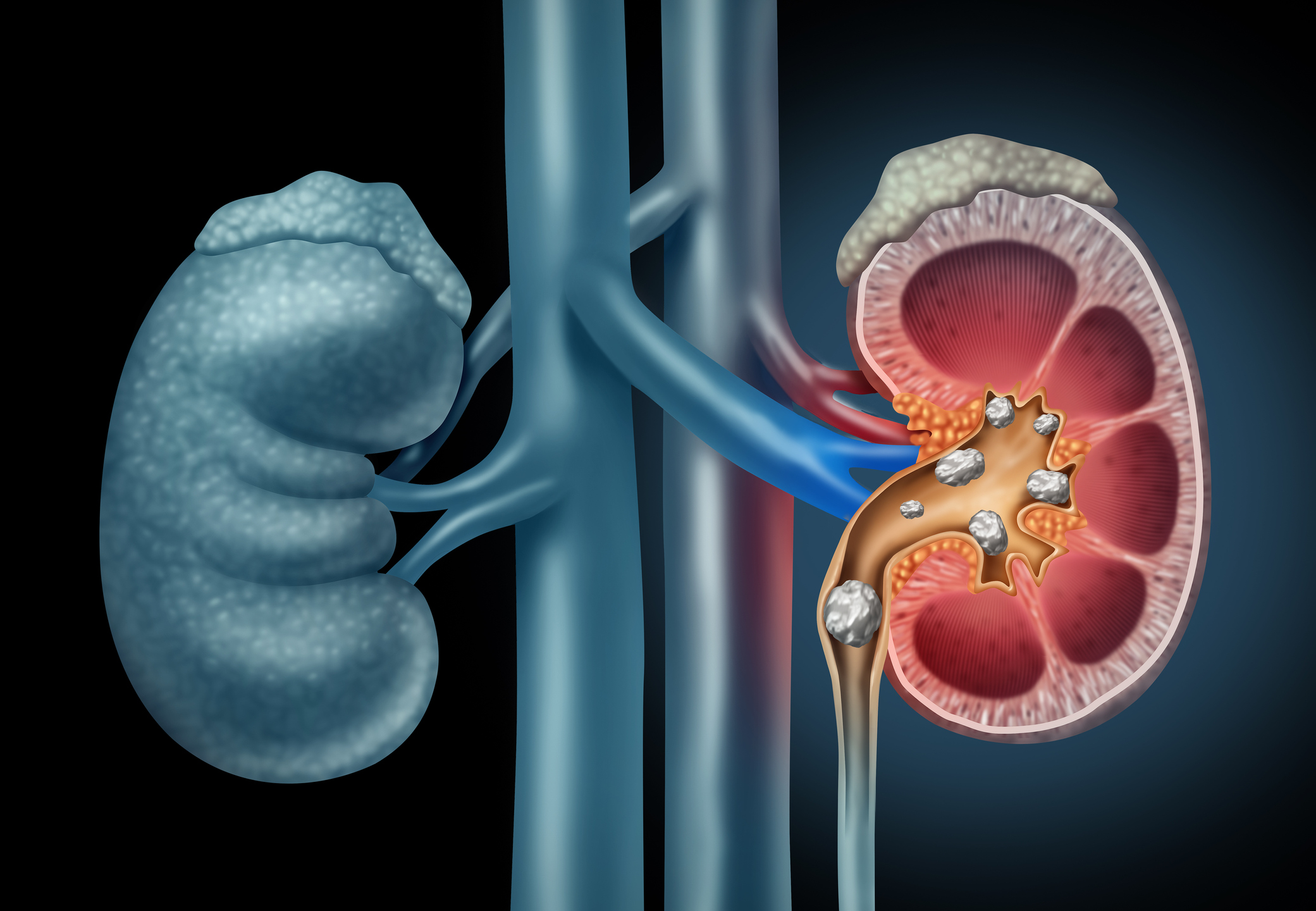 Kidney stones in a human kidney 3D illustration