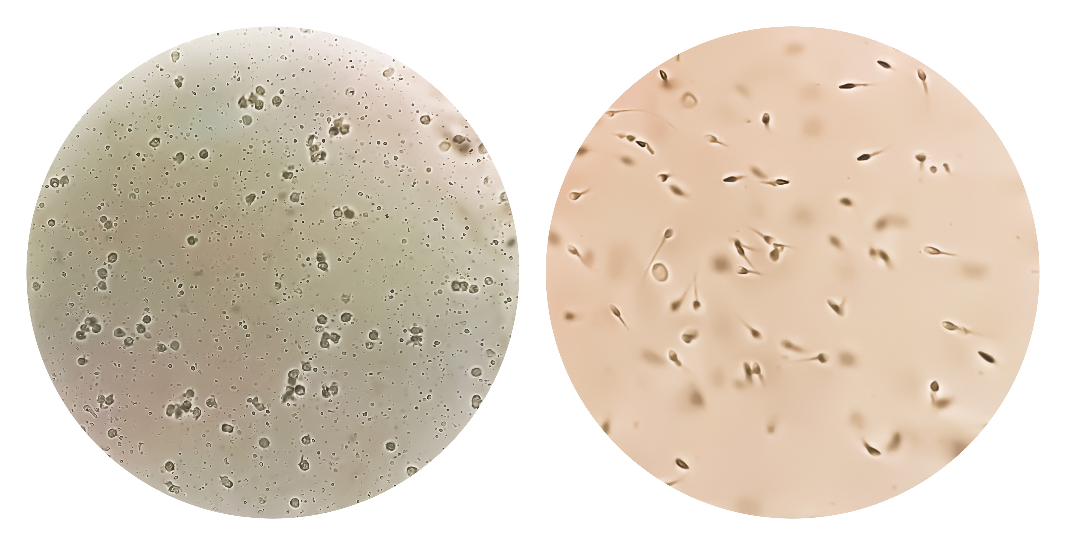 Semen analysis. The left one is showing Azoospermia with plenty pus cells the right is showing Normospermia (normal sperm).
