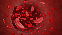 “A visual rendering of sickle cell disease, a genetic disorder that affects the shape of red blood cells (Photo by Getty Images).