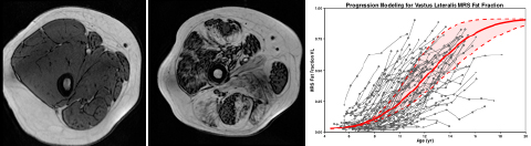 Figure 1. Left transaxial image of the upper leg from a healthy subject (left) and patient with DMD (middle). Plot of the progressive increase in fat fraction in patients with DMD with age (right). 