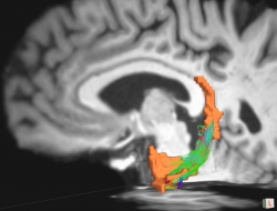 This brain image of a person with Parkinson’s disease shows white matter connections (highlighted in green, blue and red) between two regions of the brain important for memory (highlighted in orange). Illustration by Jared Tanner. Rendering with TrackVis.