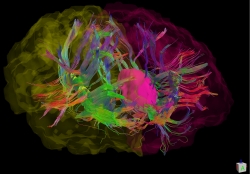 In an illustration of the brain of a person with Parkinson’s disease, white matter fibers connect to the caudate nuclei. Both are key structures involved in cognitive processing speed, and are a focus of a new UF investigation. Image data collected from a previous NIH-funded study led by Catherine Price, Ph.D. Illustration by Jared Tanner, Ph.D.