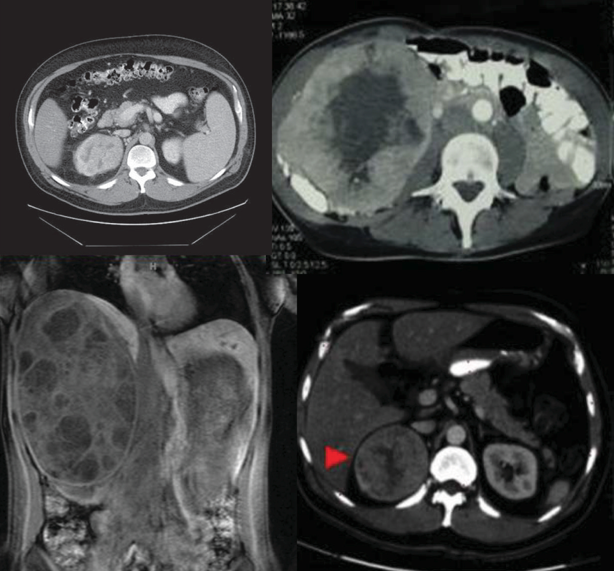 Examples of CT scans demonstrating large kidney tumors removed by laparoscopic radical nephrectomy