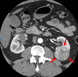 Examples of CT scans demonstrating large 6 cm left  kidney tumor (red arrows), large bilateral symptomatic kidney cysts (yellow arrows) and poorly functioning obstructed left kidney (green arrows) all  treated by LESS surgery.