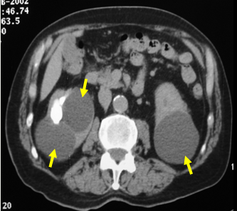 Examples of CT scans demonstrating large 6 cm left  kidney tumor (red arrows), large bilateral symptomatic kidney cysts (yellow arrows) and poorly functioning obstructed left kidney (green arrows) all  treated by LESS surgery.