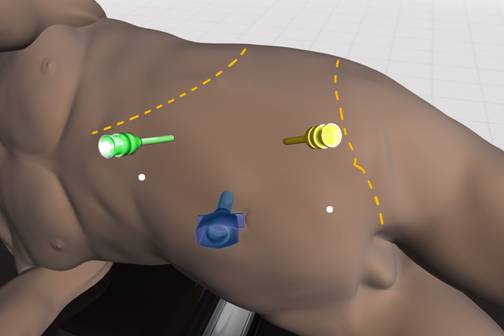  Figure 3. Trocar configuration for laparoscopic renal cyst ablation (courtesy of Intuitive Surgical Inc, Sunnyvale, CA).