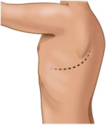 Lateral Thoracotomy Incision