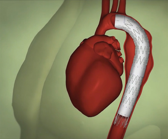 Long, thin tubes known as catheters are guided through using an X-ray to obtain real-time images and a stent graft is inserted where the aneurysm is located (Figure 2).