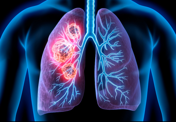 Medical Illustration of lung cancer - cancerous area in lungs.