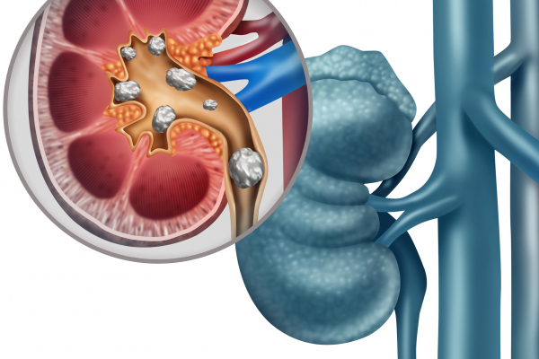 Kidney stone medical concept as an organ