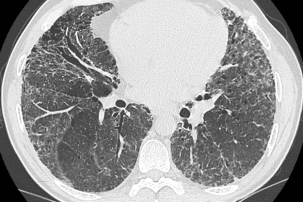 A scan of a patient with interstitial lung disease